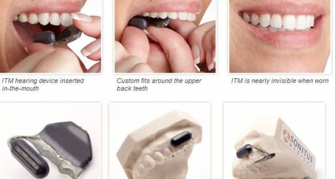 Chew your ear off!-Sonitus Soundbite Hearing Aid